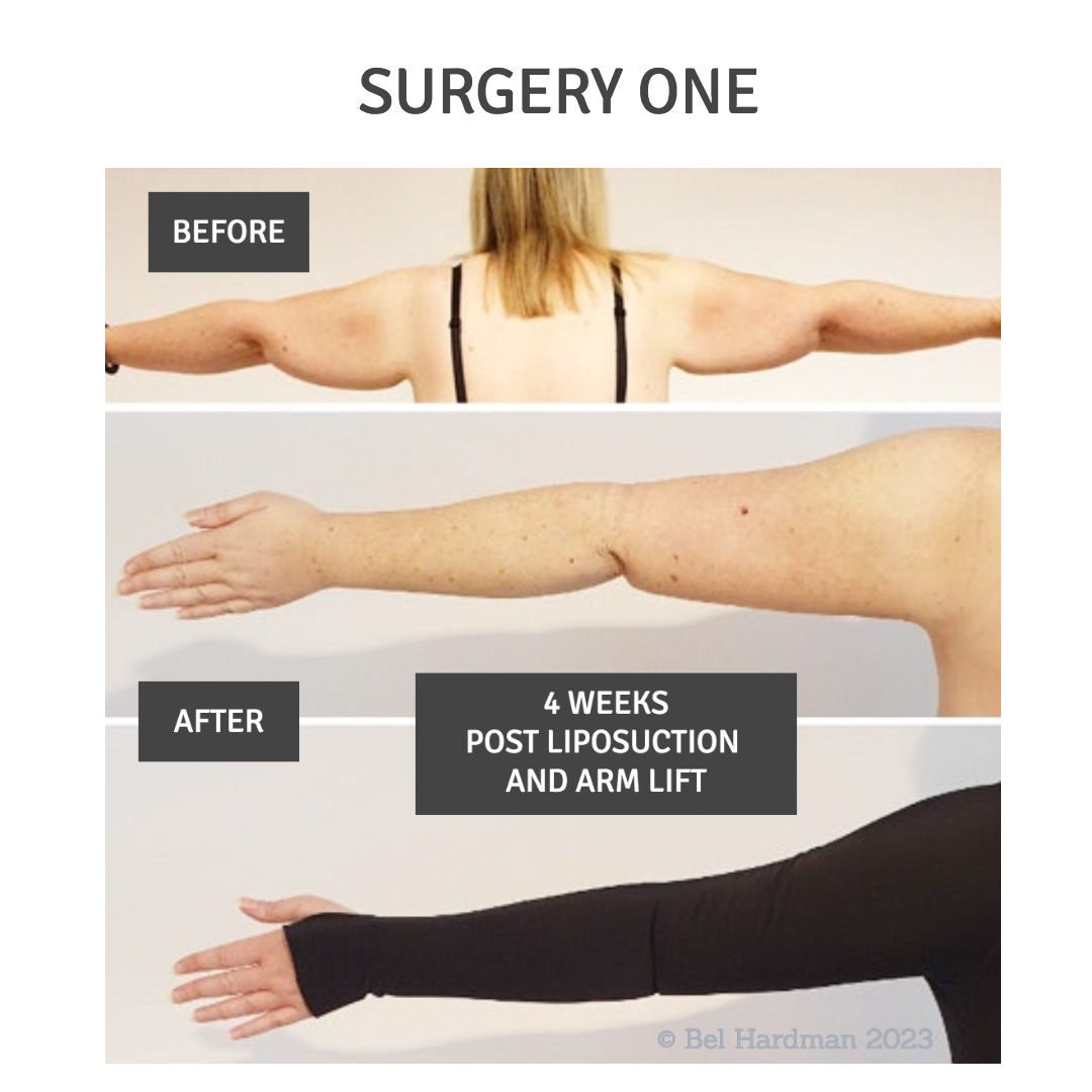 before and after 4 weeks post surgery pictures of lipoedema liposuction and arm lift carried out 